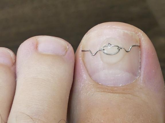 traitement ongle du pied